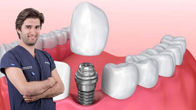 Dental İmplantlar