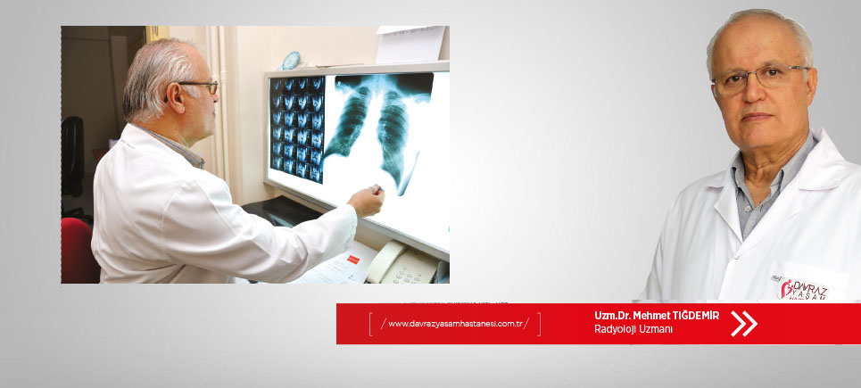 Ailesinde böbrek taşı olanlar yılda bir USG yaptırmalı